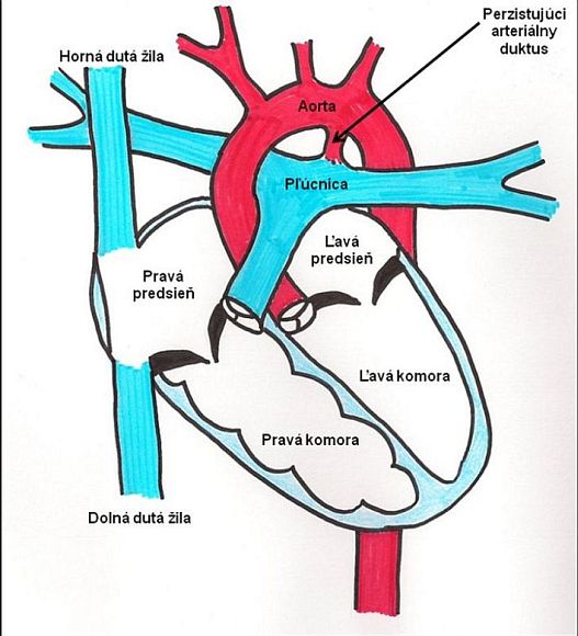 Schématické znázornenie perzistujúceho arteriálneho duktu