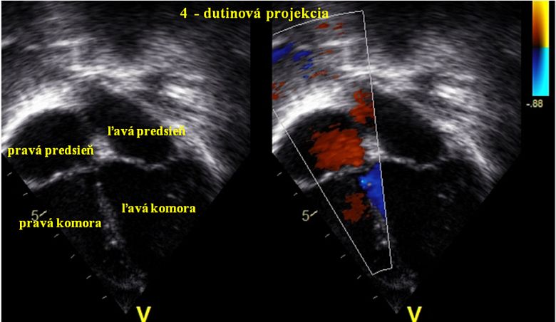 Ultrazvukový obraz 4 dutín srdca
